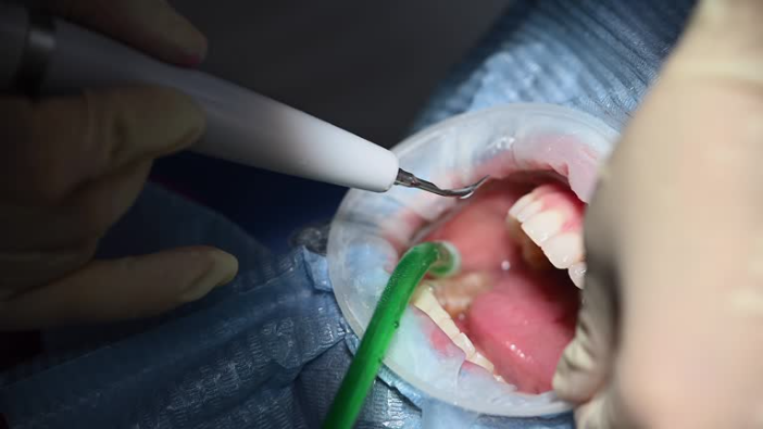 dentist-doing-emergency-tooth-extraction-procedure-to-the-patient