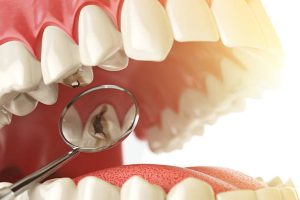 Dental-fillings-and-its-types