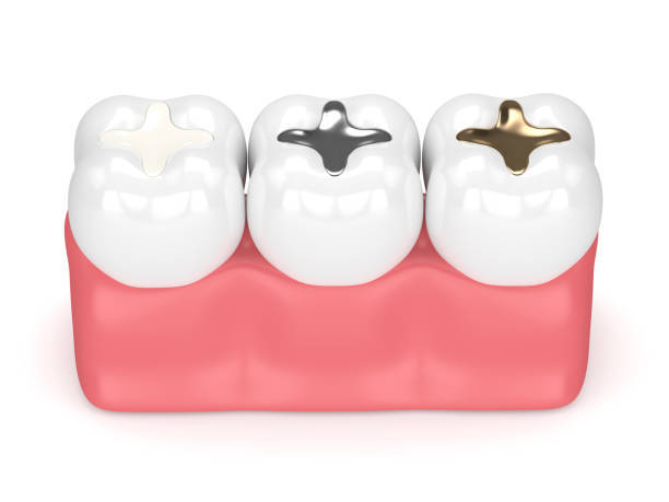 silver-gold-dental-fillings