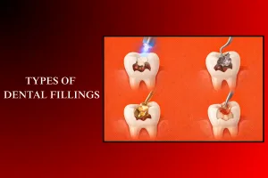 types of dental fillings