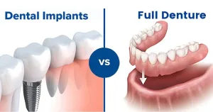 dentures-vs-implants-detailed-comparison