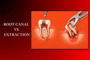 root canal vs extraction