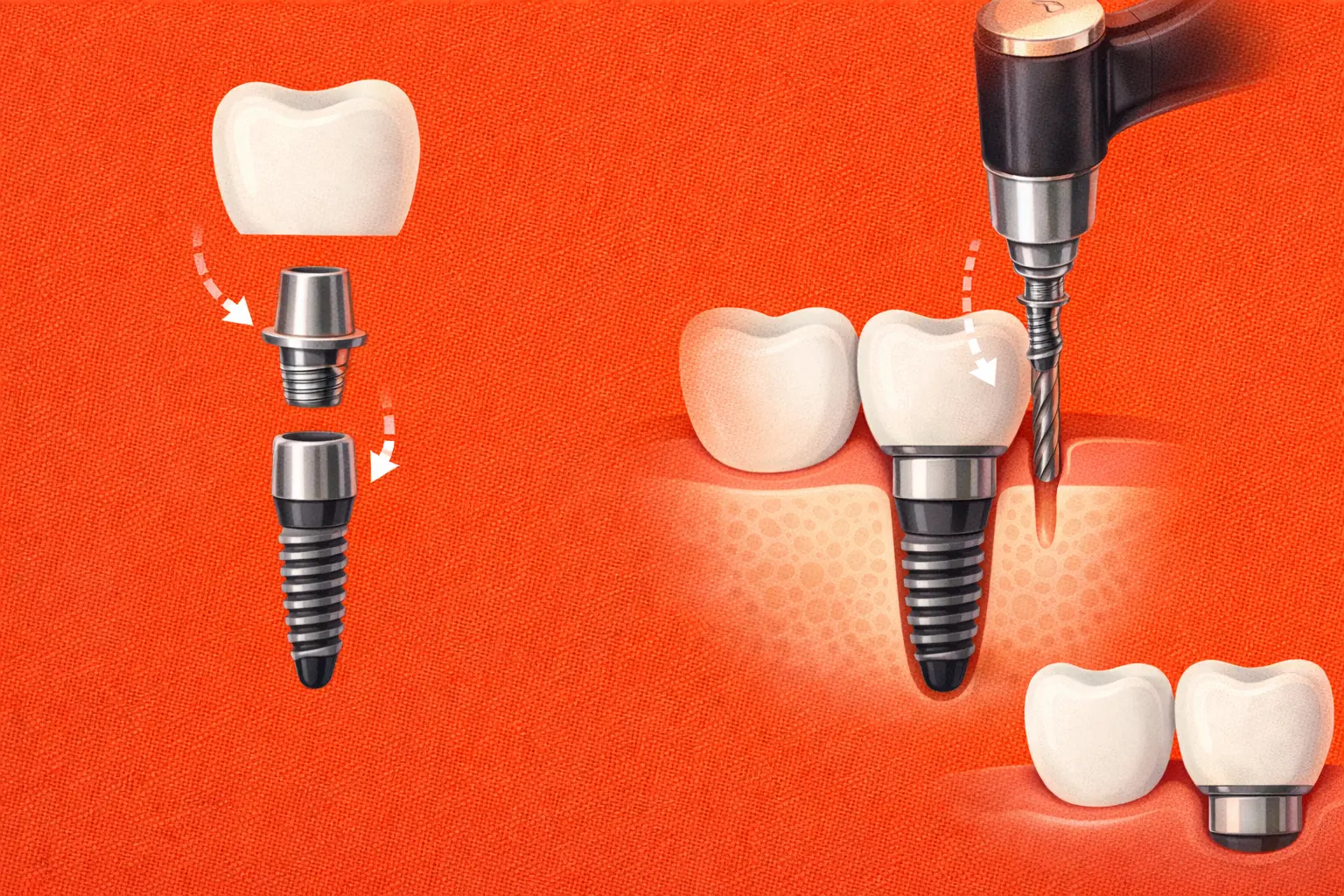 understanding dental implants