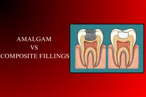 amalgam vs composite fillings