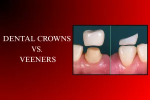 dental crowns vs veeners