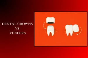dental crowns vs veneers