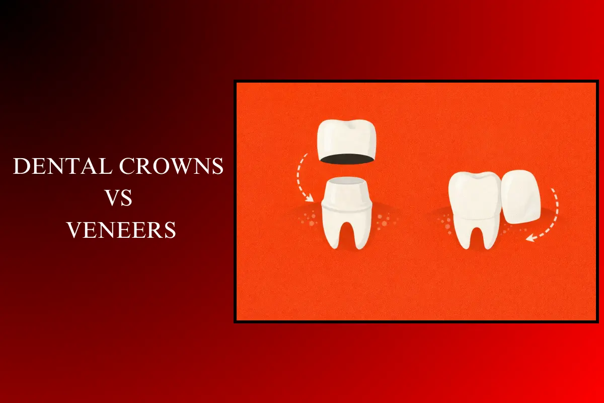 dental crowns vs veneers
