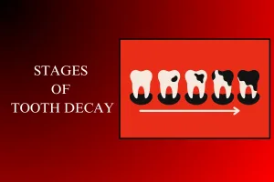 stages of tooth decay