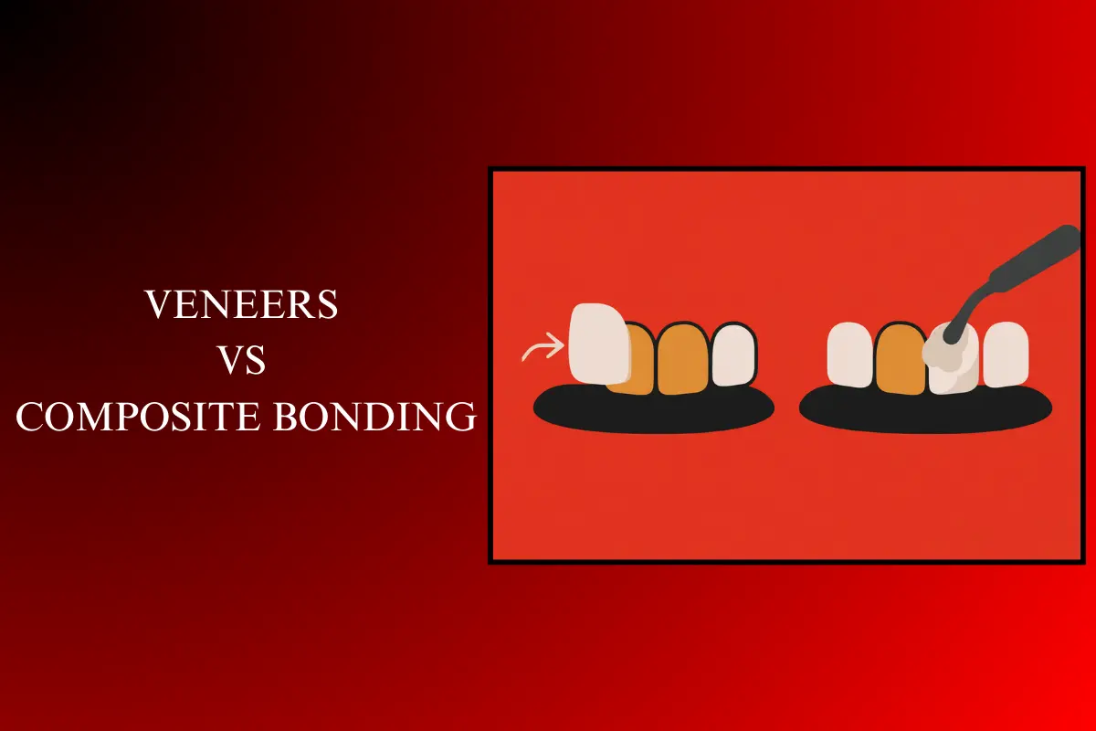 Veneers vs Composite Bonding