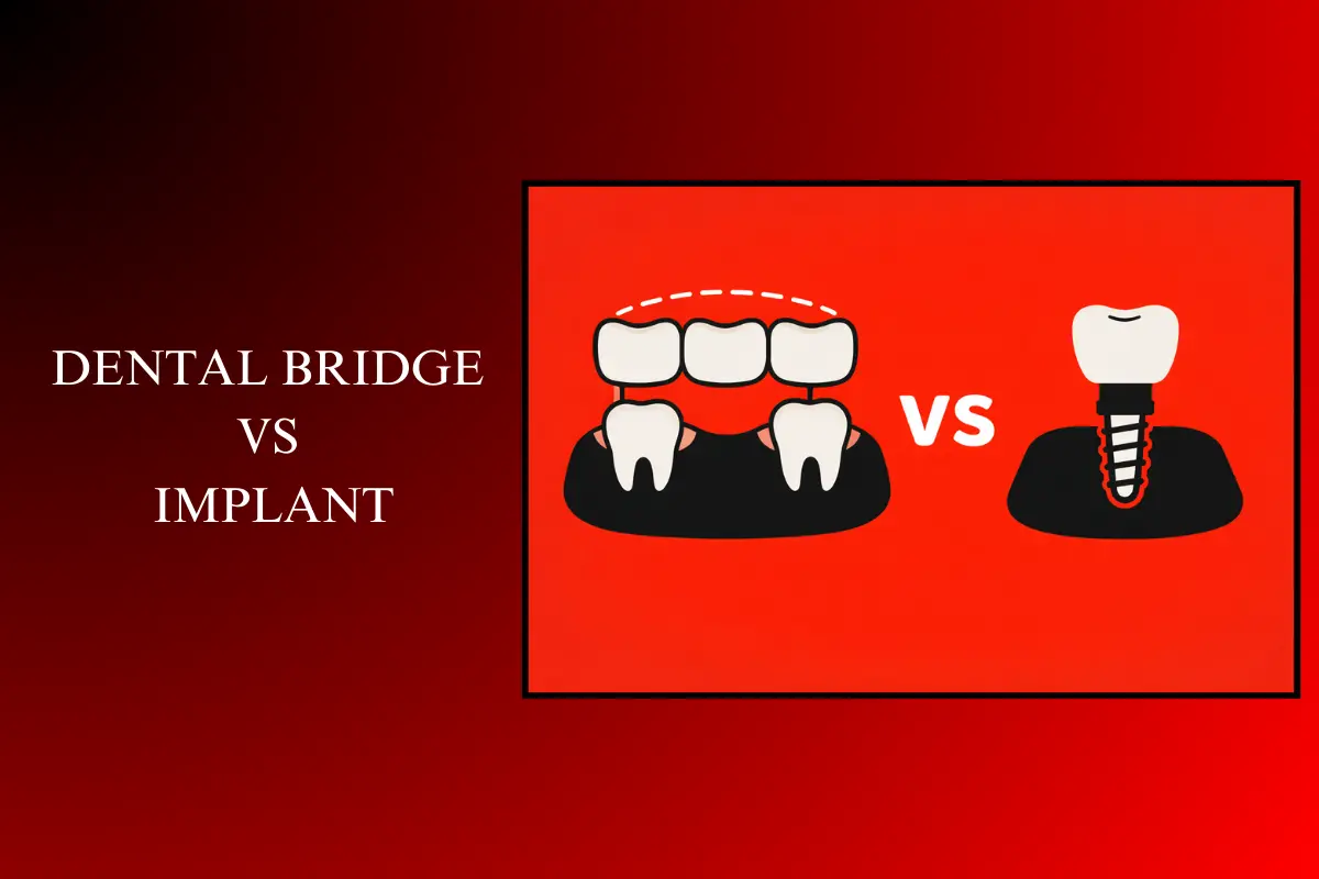 dental bridge vs implant