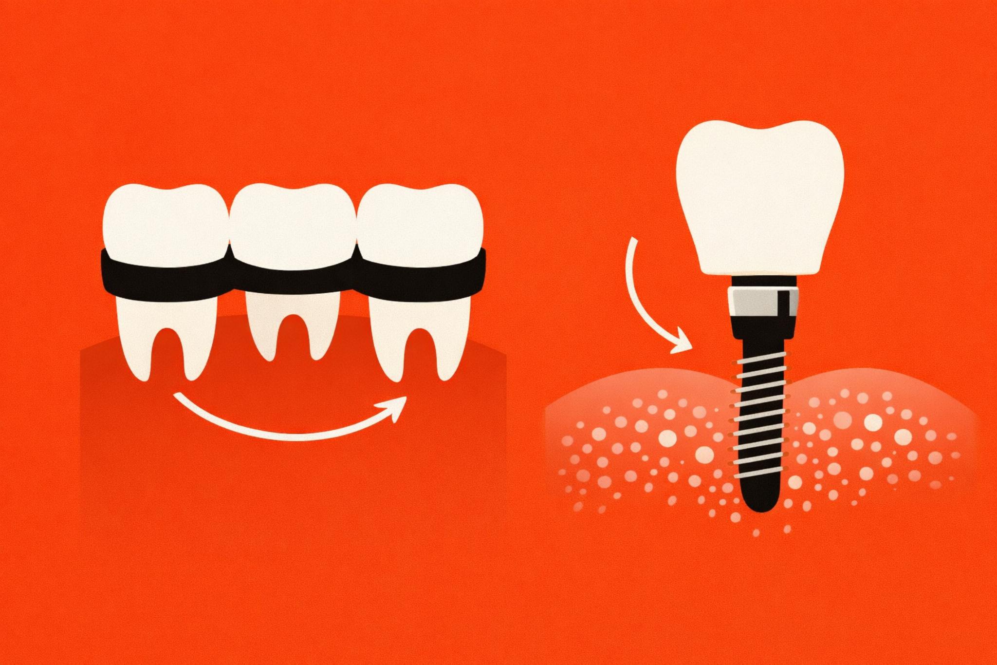 Dental Bridge vs Implant