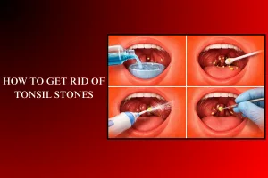 how to get rid of tonsil stones