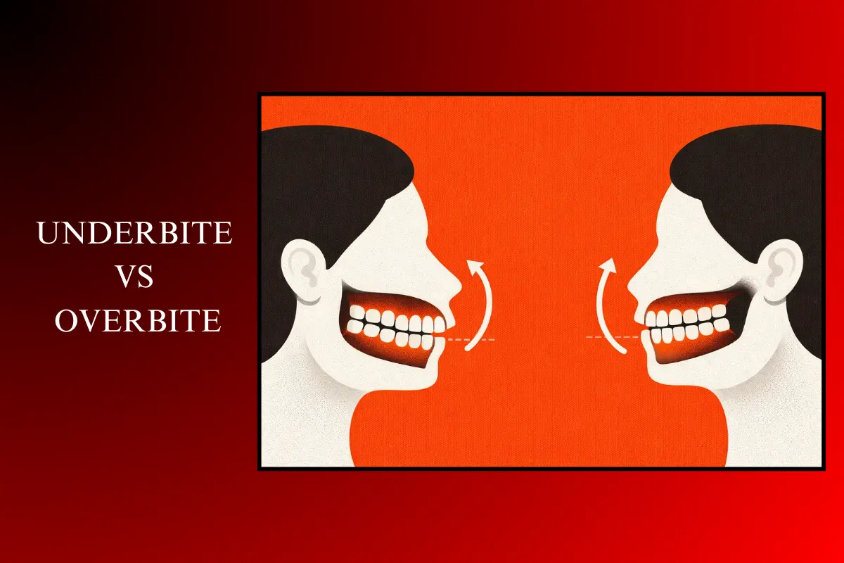 underbite vs overbite