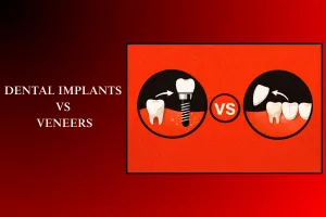 dental implants vs veneers