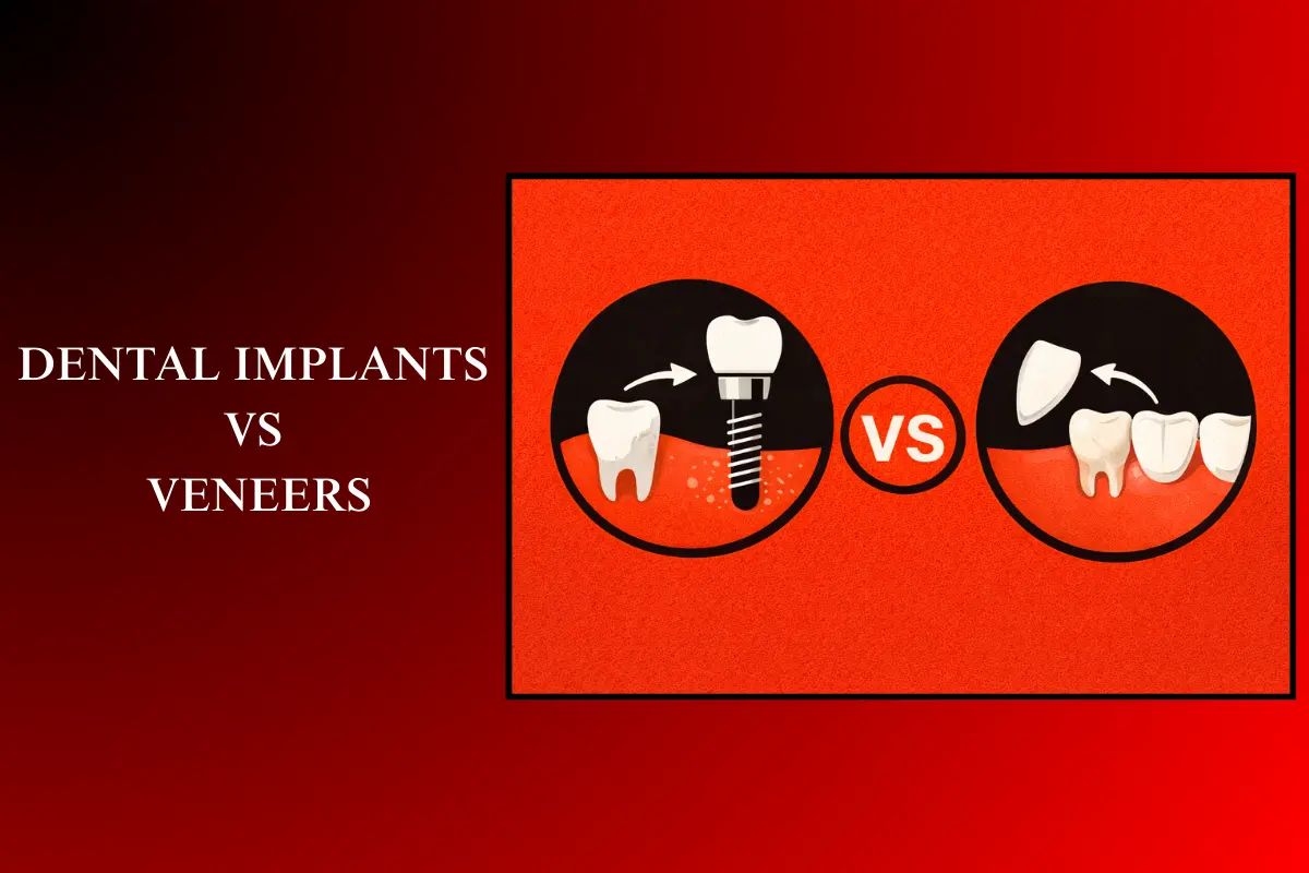 dental implants vs veneers