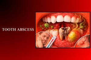 tooth abscess