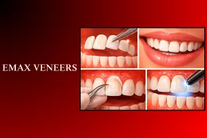 emax veneers