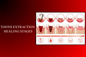 tooth extraction healing stages