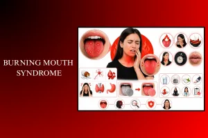 burning mouth syndrome