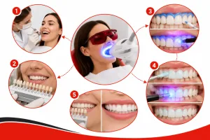 how does laser teeth whitening work