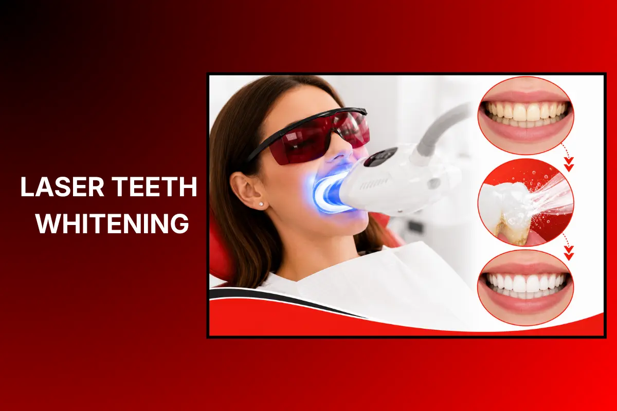 laser teeth whitening