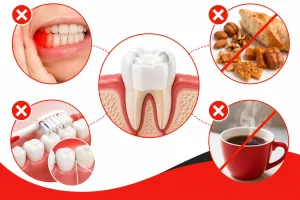 what should you absolutely avoid doing after a root canal