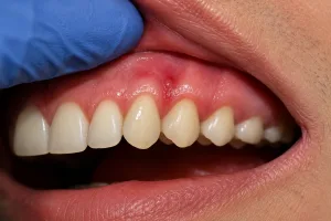gum disease