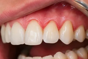 signs of gum recession2