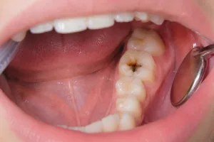 tooth decay