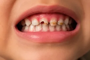 tooth decay