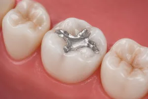 why do fillings fall out