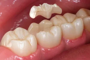 why do fillings fall out2